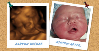 Before and after ultrasound images